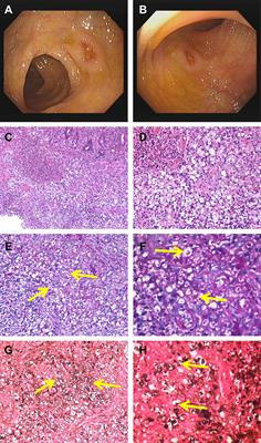 Gastrointestinal Talaromyces marneffei infection in a patient with AIDS: A case report and systematic review